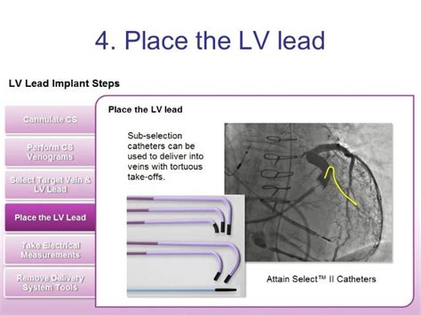 lv lead implantation|lv lead placement in therapy.